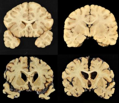 Former NFL player confirmed as 1st diagnosis of CTE in living patient