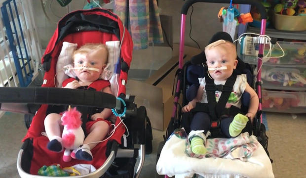 Formerly conjoined twins able to go home for the holidays