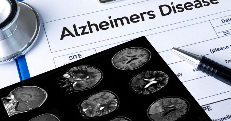 Alzheimer’s costs U.S. $277 billion a year – and rising