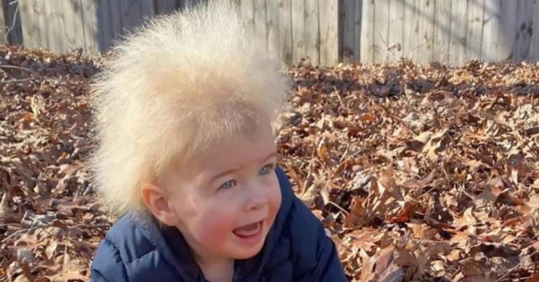 Boy has uncombable hair syndrome