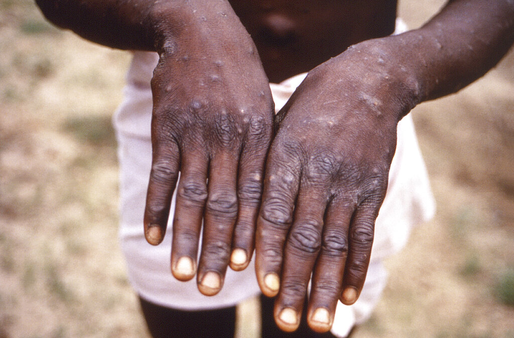 This 1997 image provided by the CDC during an investigation into an outbreak of monkeypox, which took place in the Democratic Republic of the Congo (DRC), formerly Zaire, and depicts the dorsal surfaces of the hands of a monkeypox case patient, who was displaying the appearance of the characteristic rash during its recuperative stage. As more cases of monkeypox are detected in Europe and North America in 2022, some scientists who have monitored numerous outbreaks in Africa say they are baffled by the unusual disease's spread in developed countries. (CDC via AP)