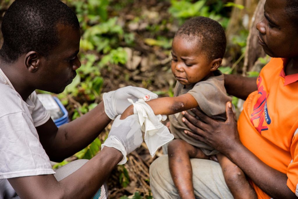 A child affected by monkeypox, sits on his father's legs while receiving treatment at the centre of the International medical NGO Doctors Without Borders (Medecins sans frontieres - MSF), in Zomea Kaka, in the Lobaya region, in the Central African Republic on October 18, 2018. - Monkeypox is a contagious disease, without remedy, which heals itself, but who can kill if not treated in time. Since May 2018, the monkeypox virus, which spreads in tropical Africa, has become a "public health threat" in the Central African Republic, according to the Pasteur Institute of Bangui. (Photo by CHARLES BOUESSEL / AFP) (Photo credit should read CHARLES BOUESSEL/AFP via Getty Images)