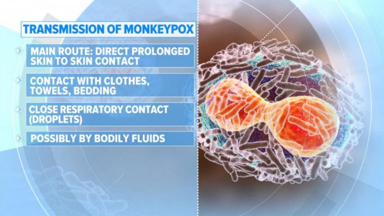 2 new cases of monkeypox in kids reported in US: What parents should know