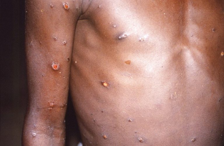 Monkeypox cases in the US surpass 5K mark