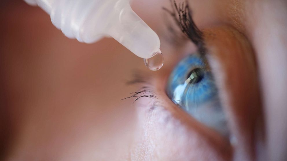 PHOTO: A woman puts an eye drop in to her eye in this undated stock photo.