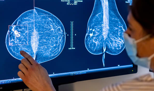 Breast cancer screenings should start at age 40 instead of 50, US panel says