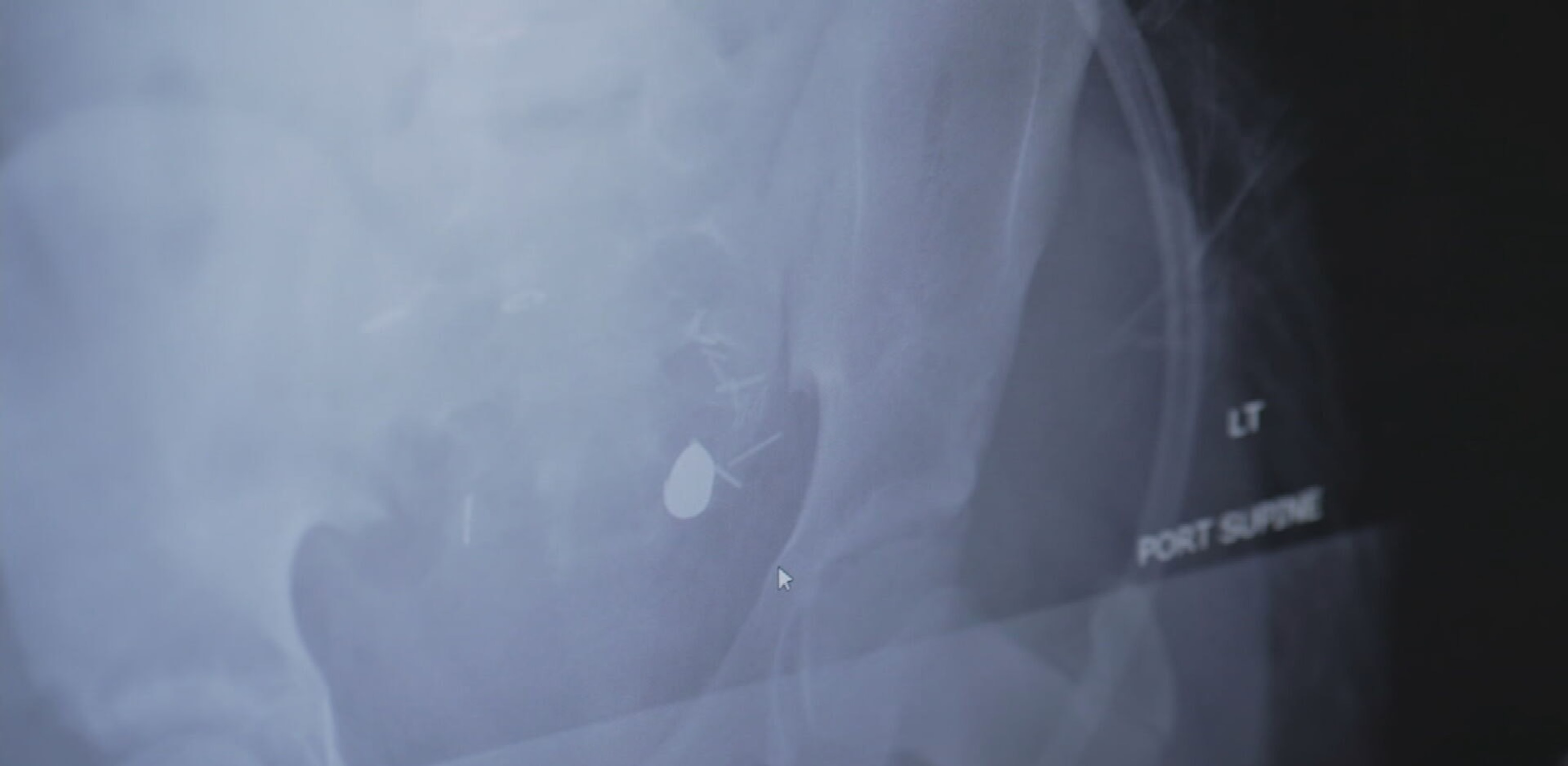 PHOTO: An X-ray shows the bullet still lodged in Aalayah Fulmore's body.