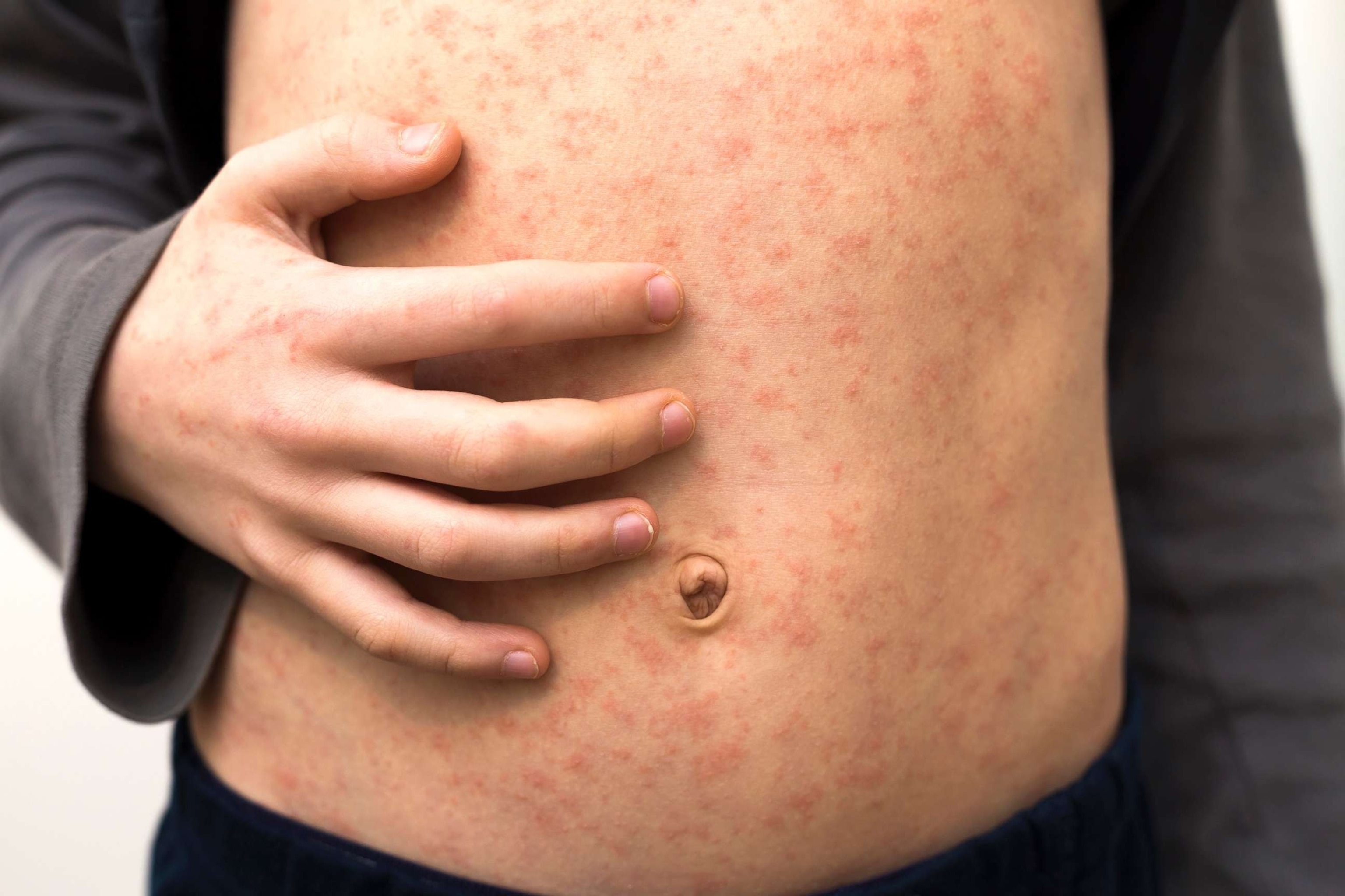 PHOTO: In this undated stock photo, a child is shown with red rash spots from measles.