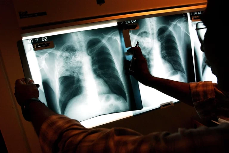 CDC: Kansas Faces ‘Largest Tuberculosis Outbreak In U.S. History’